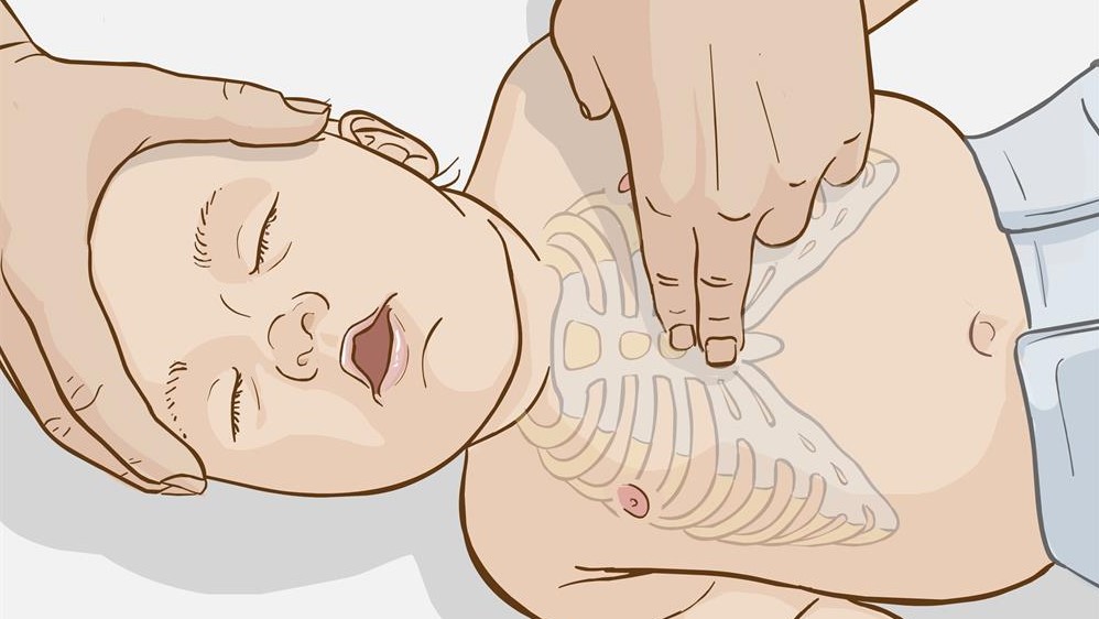 احیای قلبی تنفسی یا CPR کودک زیر یک سال