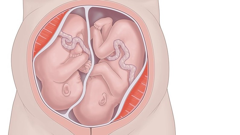 وضعیت قرارگیری دوقلوها در رحم: با چه روشی زایمان می‌شوید؟
